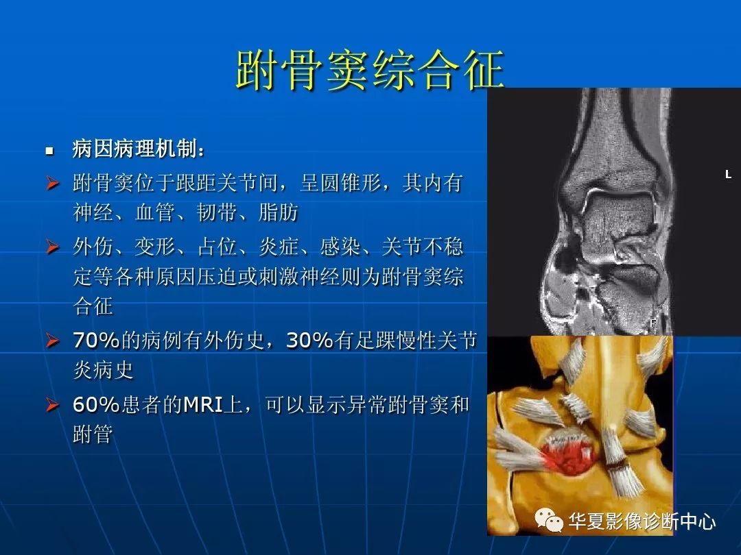 踝關節損傷的磁共振掃描技術及診斷