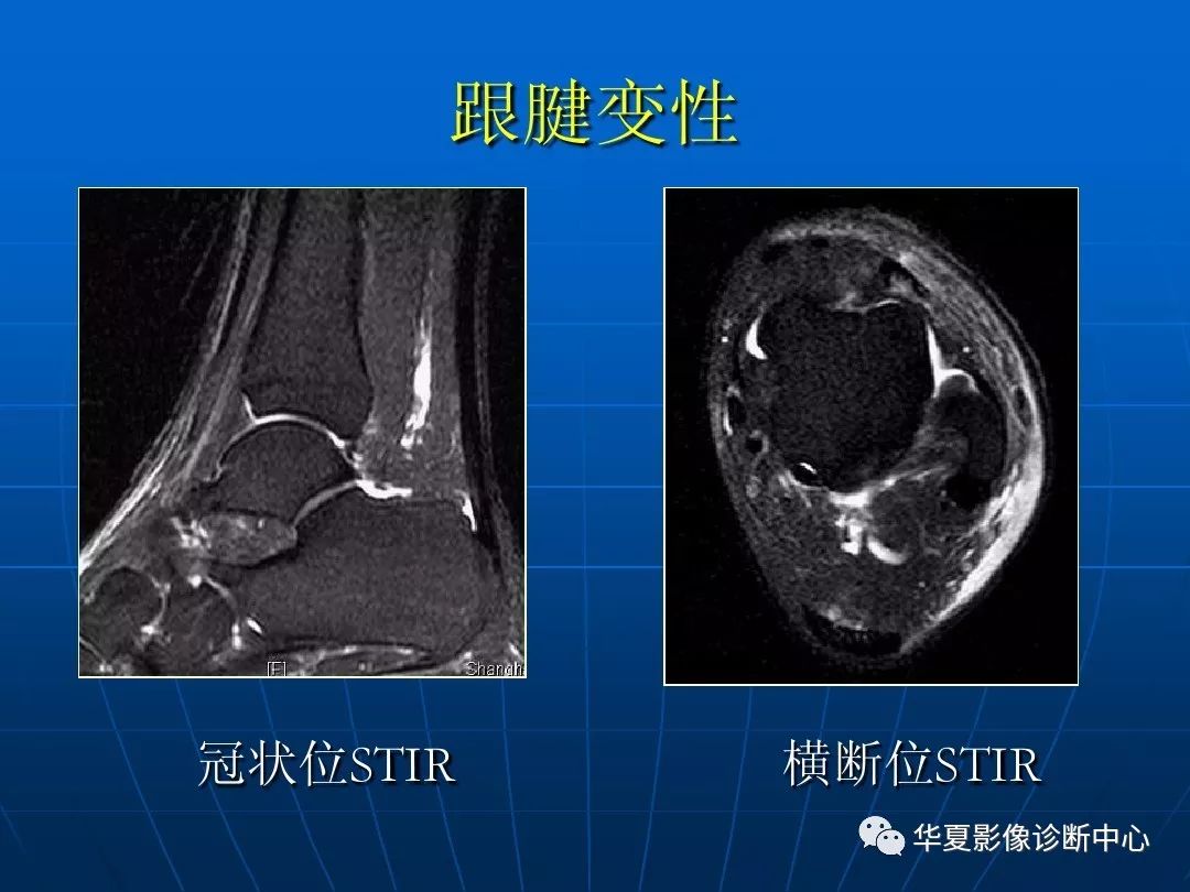 踝关节损伤的磁共振扫描技术及诊断