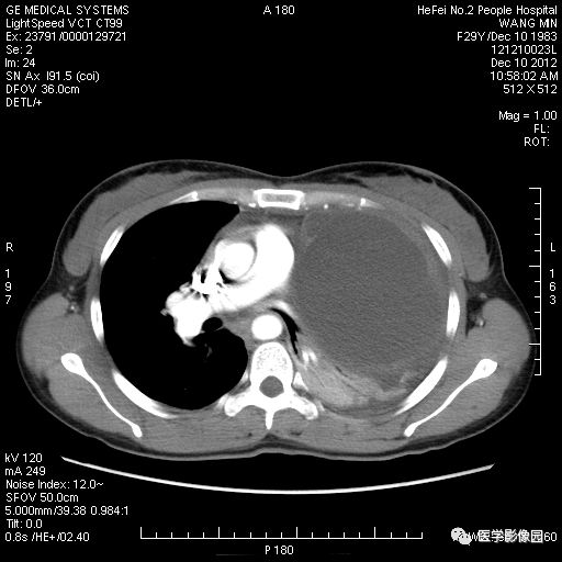 畸胎瘤影像图片