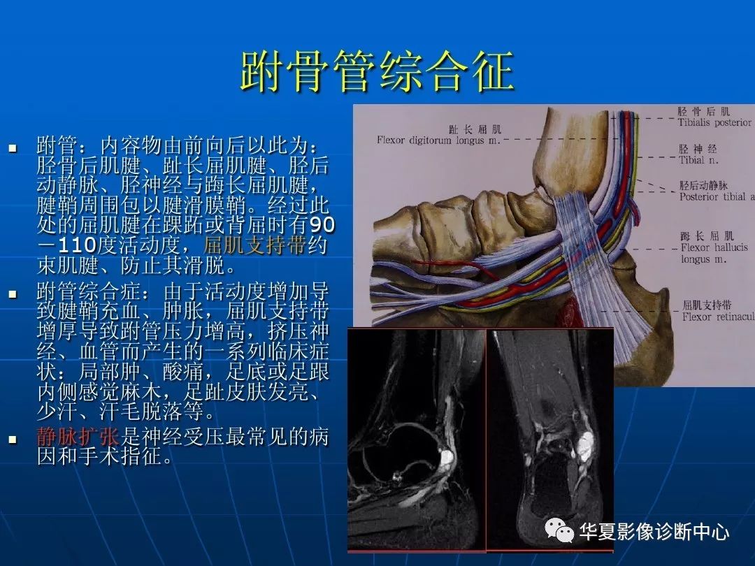 踝关节损伤的磁共振扫描技术及诊断