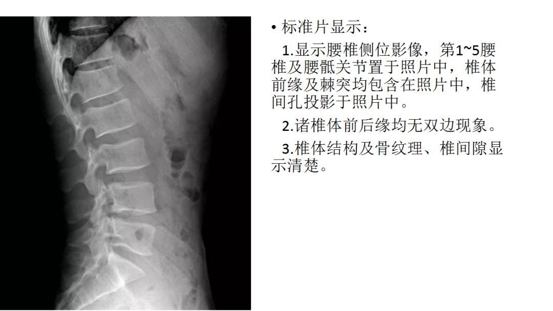 x线检查操作规范之脊柱篇