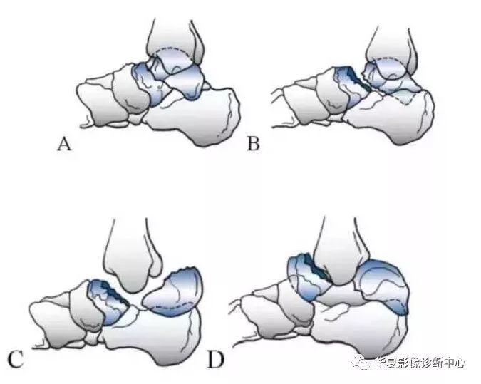 影像基礎距骨骨折分型
