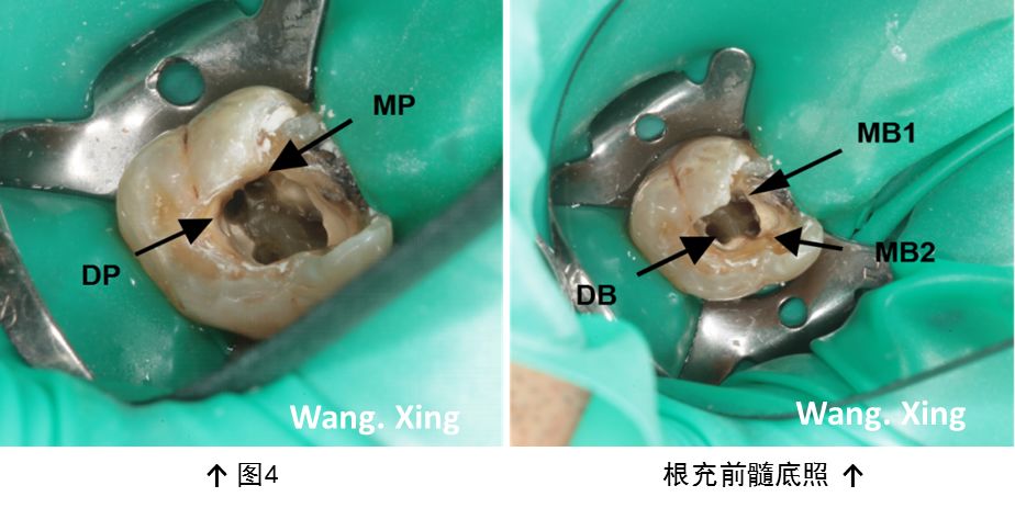 临床上对患者牙根管系统解剖的充分了解,及对感染髓腔的彻底清创和