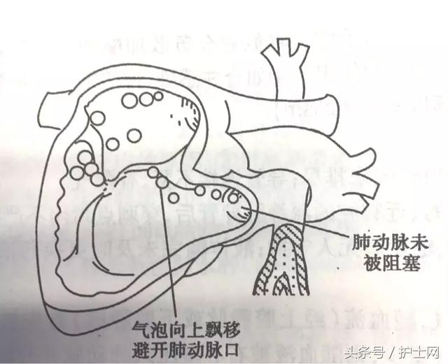 后穹窿穿刺部位图图片