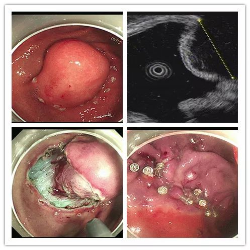 潍医附院消化内二科采用内镜下全层切除术成功治疗腔外型巨大胃间质瘤