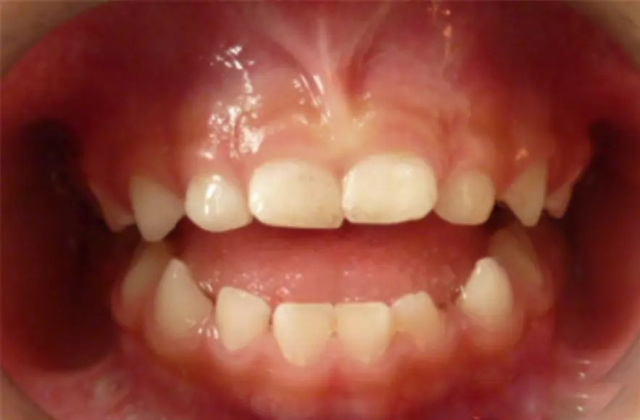 个别牙扭转深覆合俗称咬合深上中切牙间隙儿童早期矫治错颌畸形有