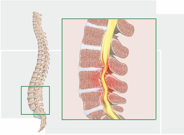 症 脊柱 治療 狭窄 管 脊柱管狭窄症の治療に効果的な方法ってなにか？体験談含む