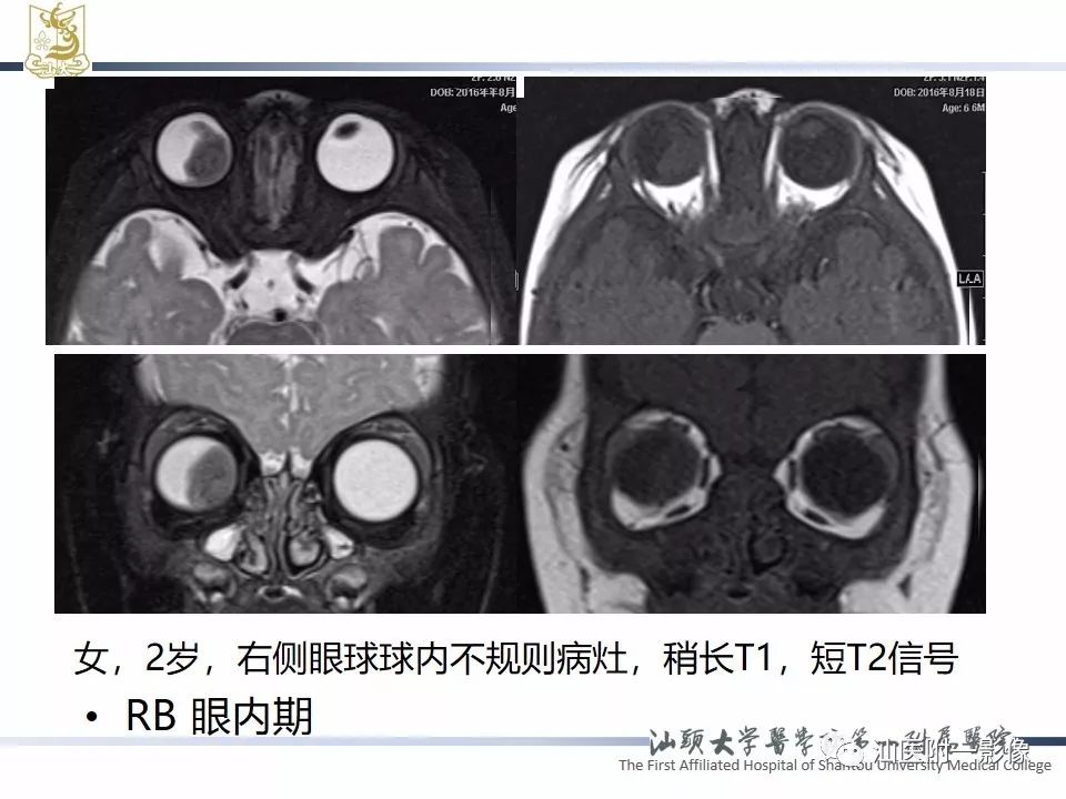 儿童白瞳症影像诊断