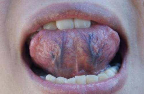 舌下青筋血瘀图片消失图片