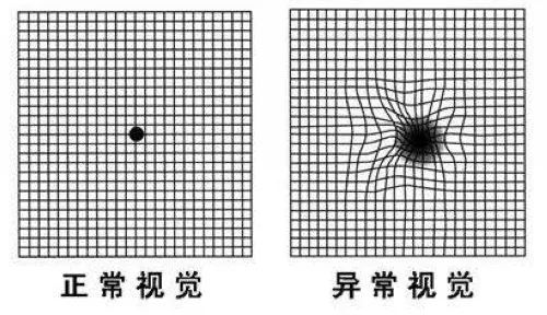 黄斑病变表格图片