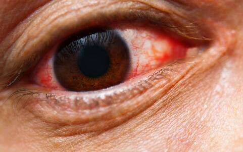 白眼球发蓝暗示贫血严重,眼睛4个症状,你中几个?