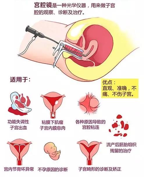 宫腔镜比传统的诊断性刮宫