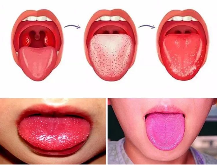 舌头颜色变化也是猩红热的典型特征,出疹初期舌头上覆盖着一层灰白色