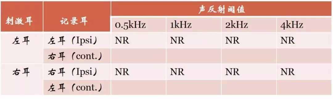 镫骨肌反射试验图解图片