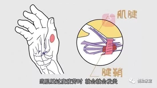 運動保健羽毛球傷病腱鞘炎是怎麼回事兒