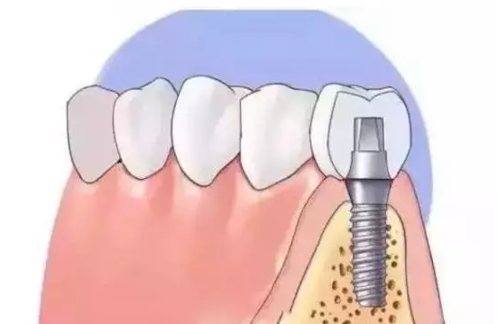 健康 正文 牙缺失修複方法眾多,其中,種植牙技術有咀嚼效率高,美觀