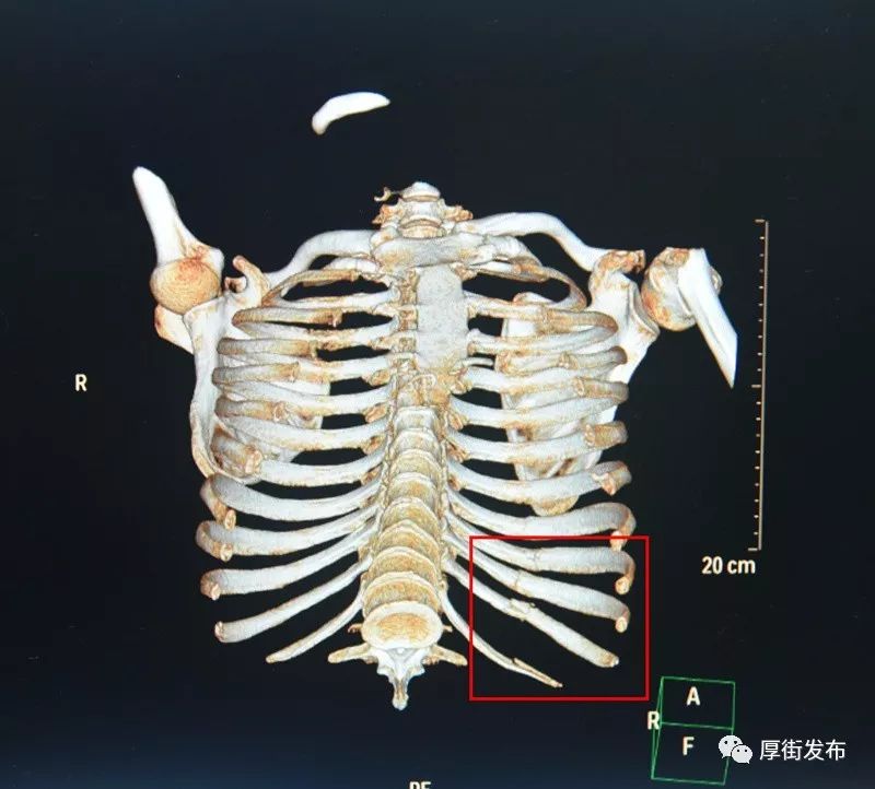 第四根肋骨图片