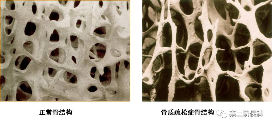 健康有约 轻松学会骨质疏松自我检查与防治