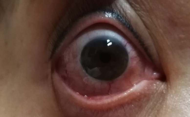 80岁爹爹习惯性揉眼睛导致左眼球感染被摘除