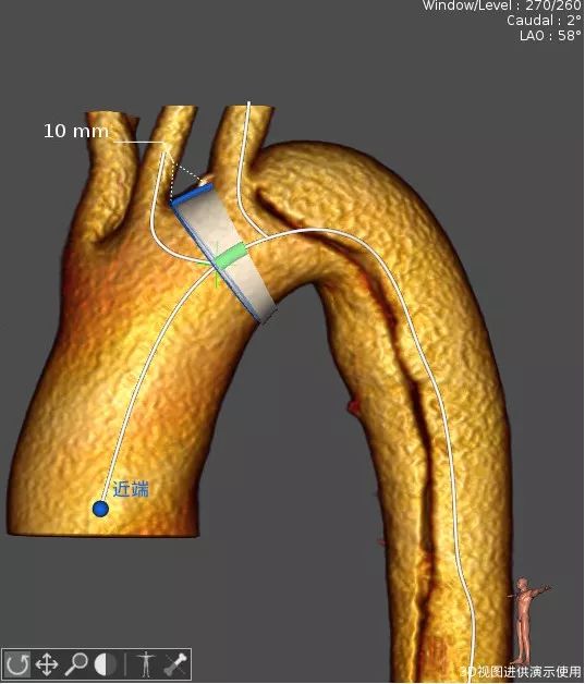 主动脉夹层三维重建图图片