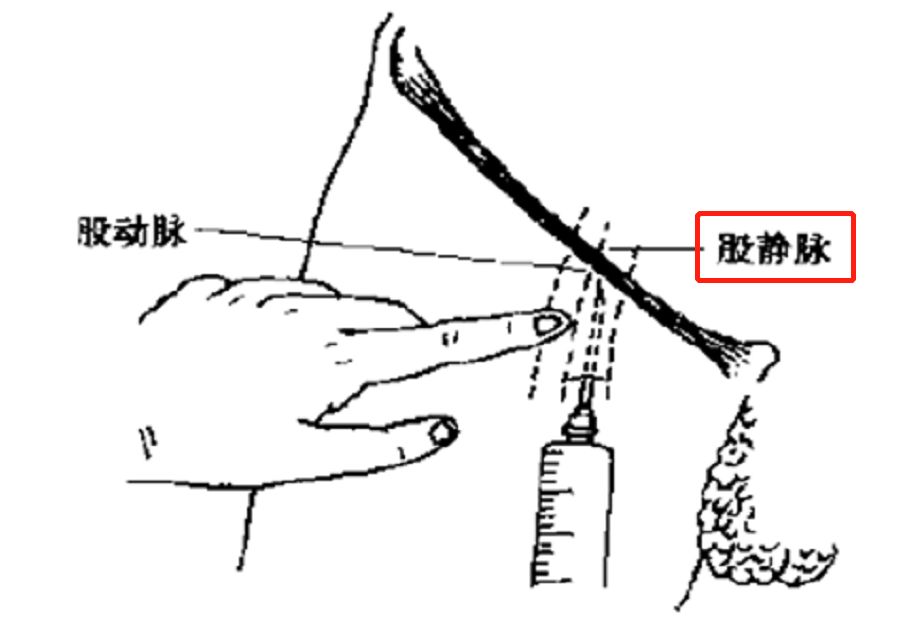 股静脉置管示意图图片