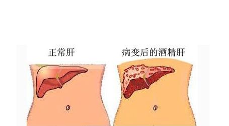 酒精肝的危害图片