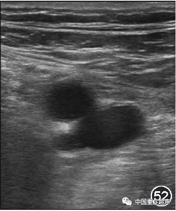 图 52 股动,静脉超声图图53 静脉内血栓形成:图53a 二维 模式下,血管