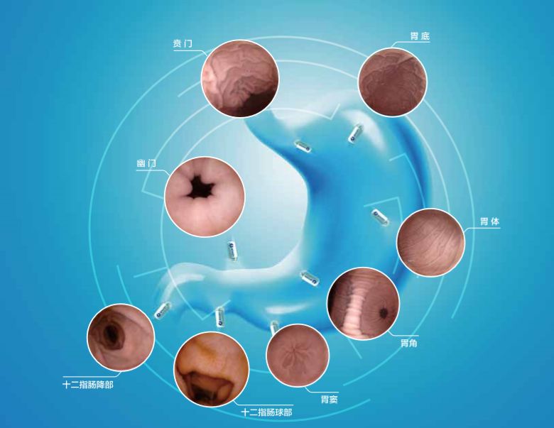 老钱推荐"窥探"你的胃,守护你的健康—胶囊胃镜!