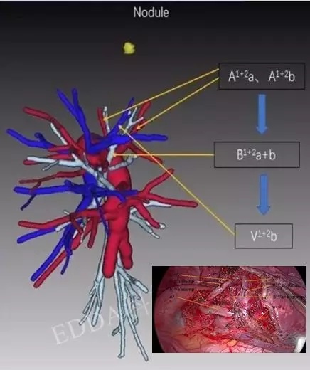 精準肺段切除病例分享iqqa - 3d lung系統肺段術前規劃,需要完善一些