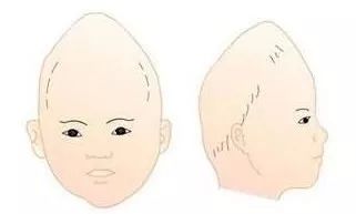 狭颅症又称颅缝早闭,表现为头颅较同龄正常儿童小或者形状异常,常伴有