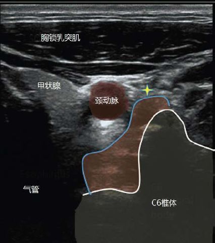 超声星状神经节阻滞图片