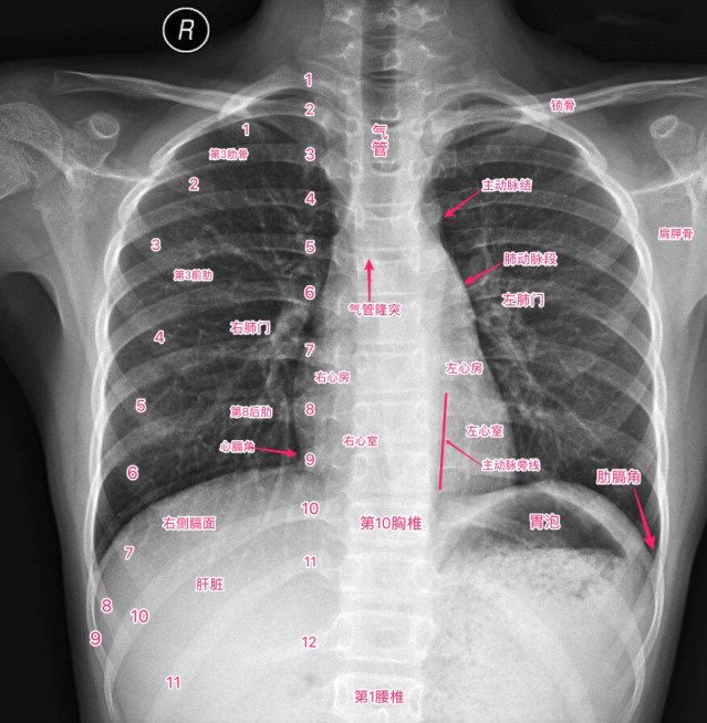 肋骨斜位图片