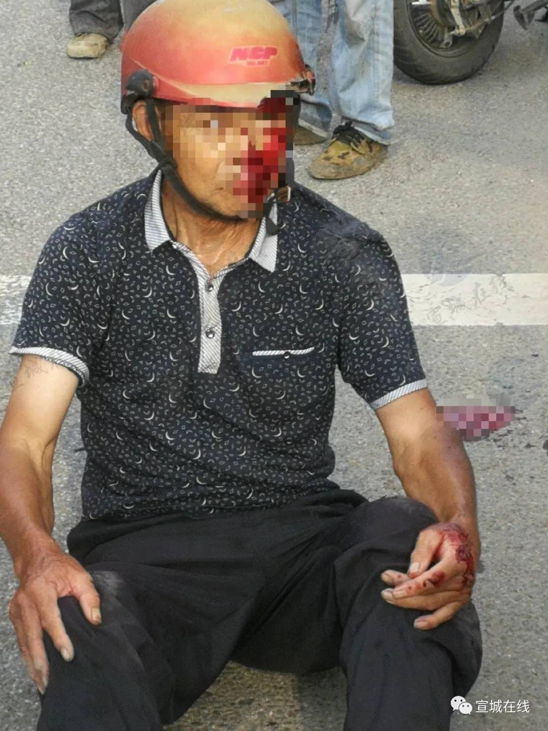 宣城发生一起交通事故伤者脸上好多血