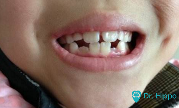 儿童换牙期间牙齿不齐怎么办?