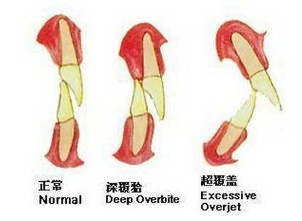 牙性前突和骨性前突图片