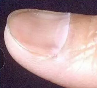 指甲会反应身体健康状态,这几种指甲状况需要当心!