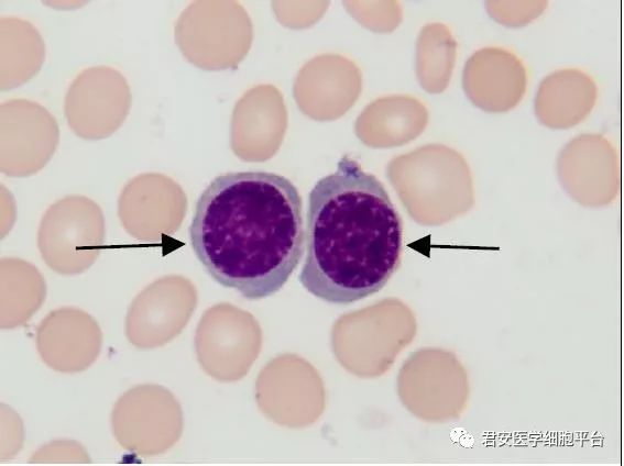 中幼红细胞2018108浆细胞2018109未成熟嗜酸性粒细胞2018110异型淋巴