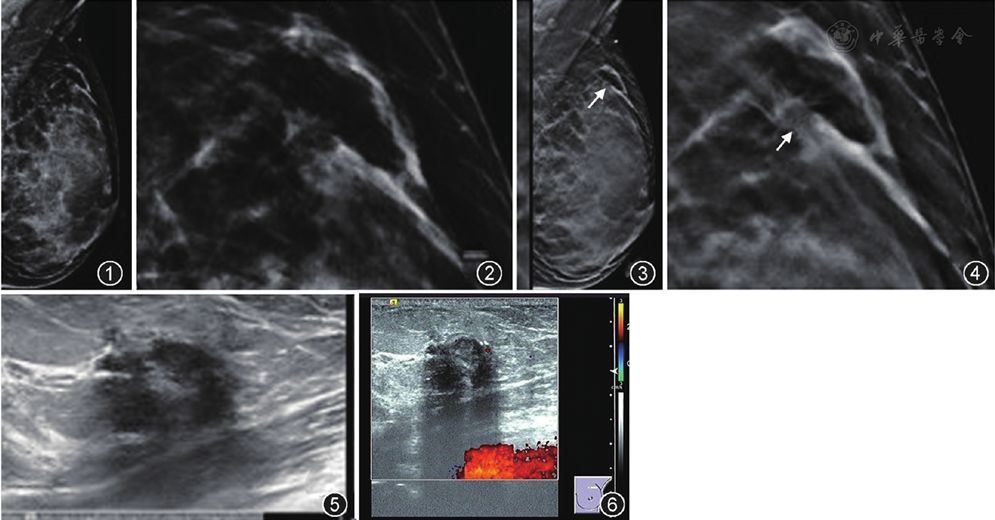 乳腺x線攝影(digital mammography,dm)表現:左乳外上象限見不規則斑