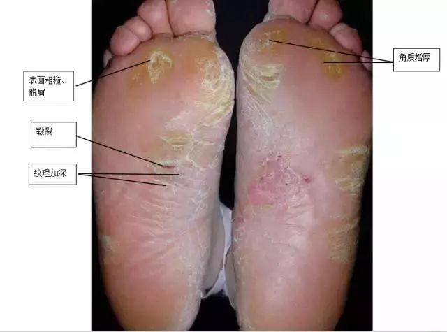 脚趾湿疹与脚气区别图图片