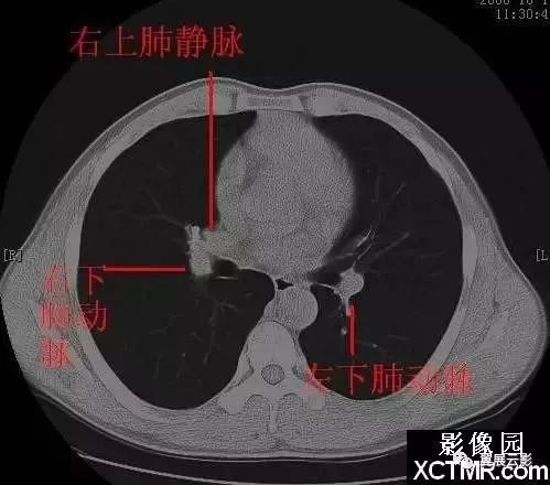 肺部ct解剖图 断层图片