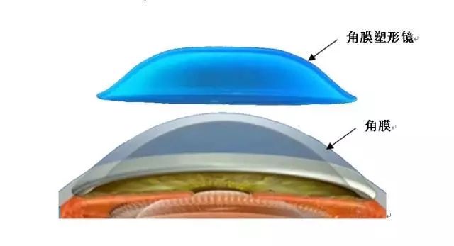 角膜塑形镜作用于角膜,改变角膜的形态,但不改变角膜的结构,对青少年
