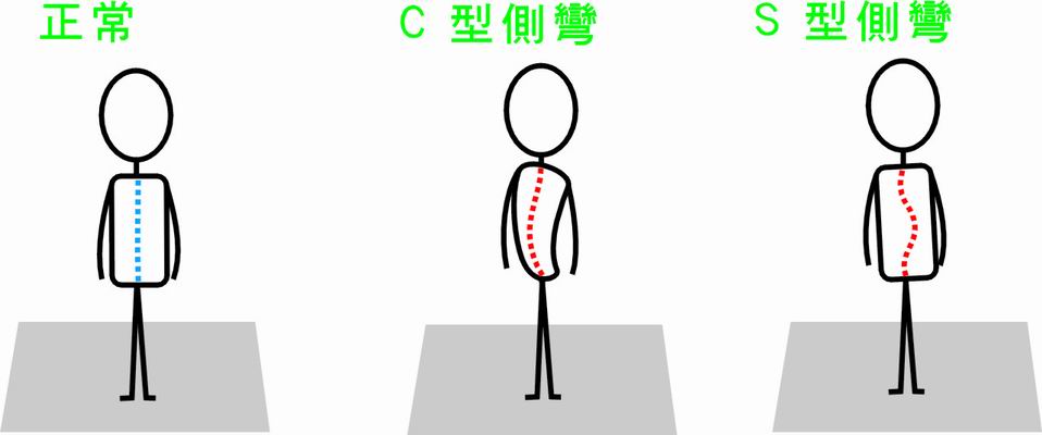 生活中這些習慣都會引起脊椎側彎衛蘭薩拉波莉無一倖免受罪