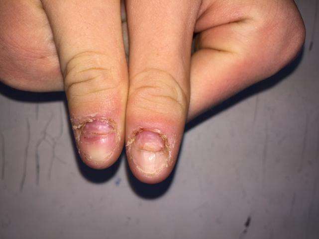 孩子十个指甲都有横纹, 是缺乏维生素吗?