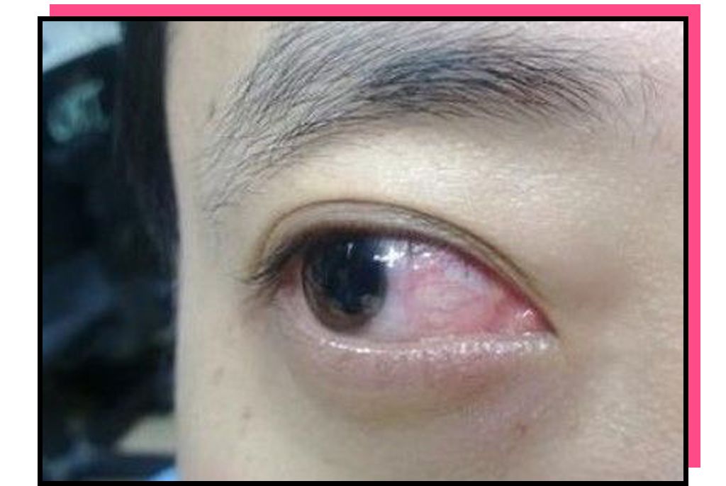 结膜就很容易发炎就会造成眼睛交叉感染假如眼线睫毛膏过期的话最亲密