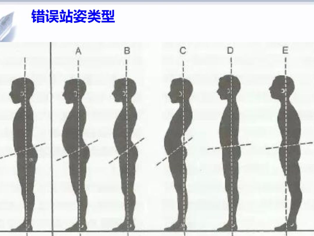 下交叉综合症图解图片