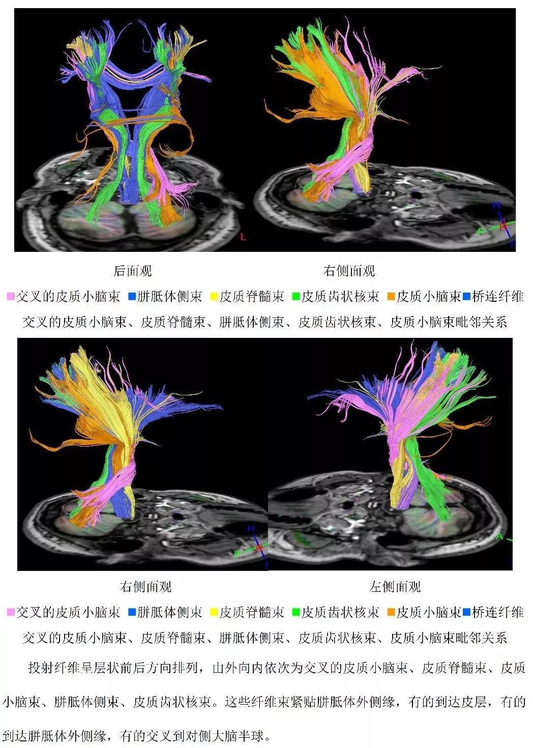 國際首先發現並命名胼連纖維(綠色)國際首先發現並命名交叉的皮質小腦