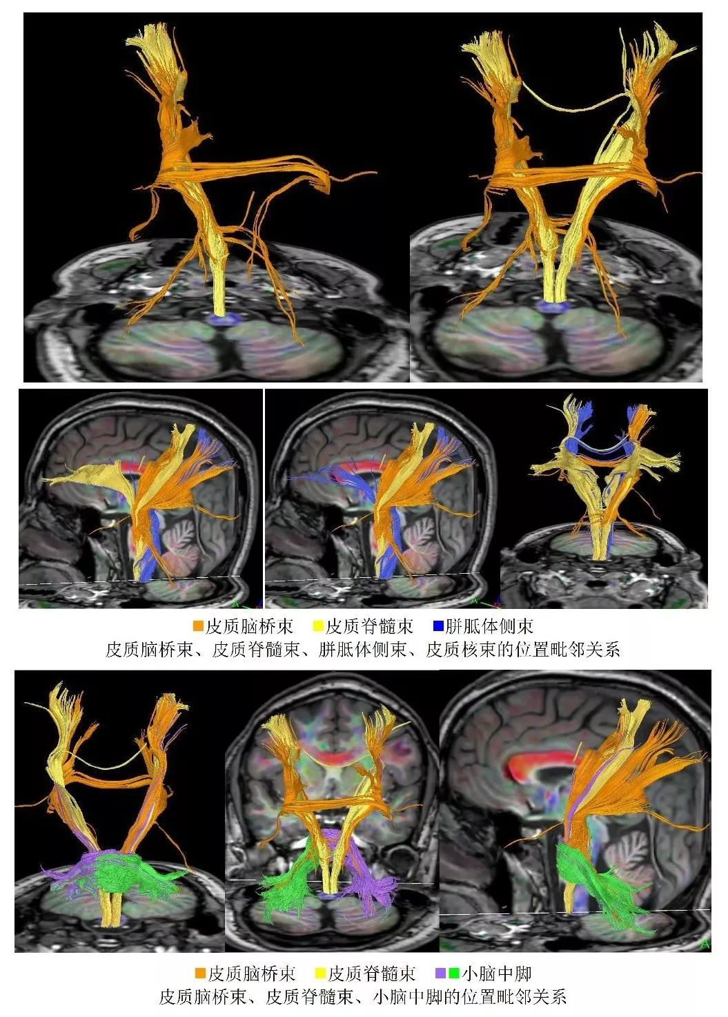 国际首先发现并命名胼连纤维(绿色)国际首先发现并命名交叉的皮质小脑