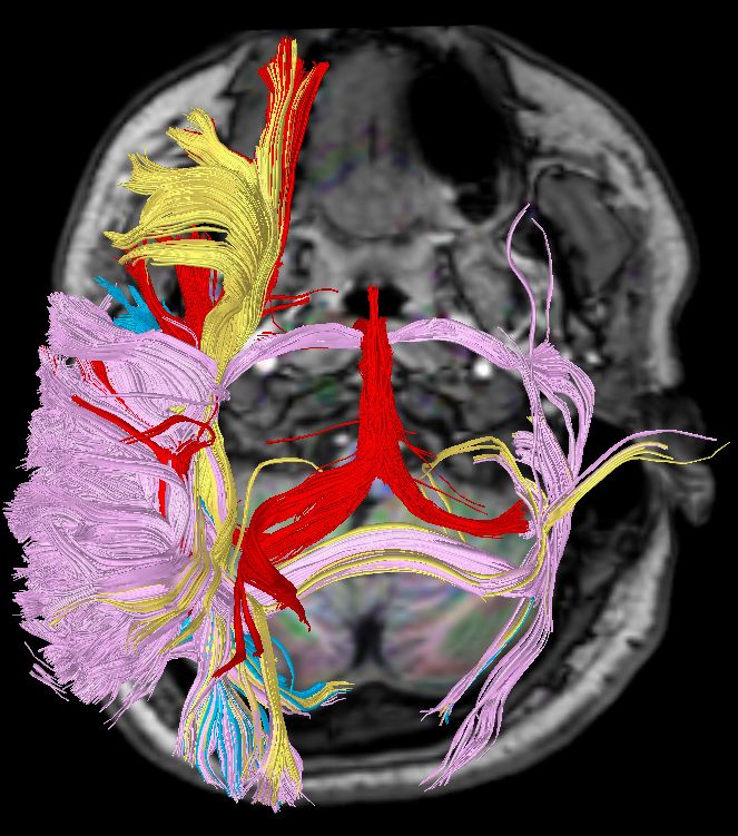 多彩大腦首部dti神經纖維束附培訓教程視頻