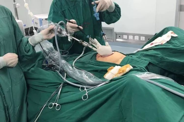 经脐单孔腹腔镜下妇科微创手术—开创无痕新时代