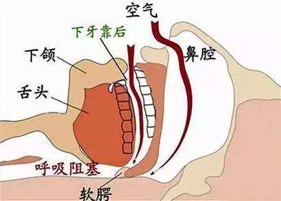 為什麼肥胖人群容易打呼嚕?